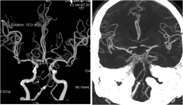 基底动脉狭窄介入治疗的病例分享,天坛医院颈动脉闭塞的介入治疗