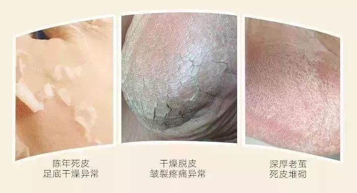 手足脱皮脚后跟干裂修复膏,奇迹第十代
