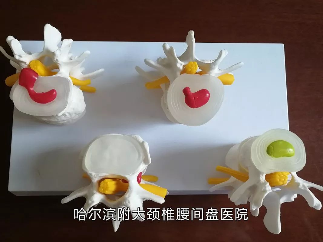 你家睡啥床？你常玩手机？腰痛难忍反复发作、久治不愈，腰间的不能承受之痛该如何缓解？