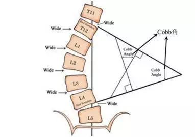 父母必看系列青少年心理健康,家长发现脊柱侧弯