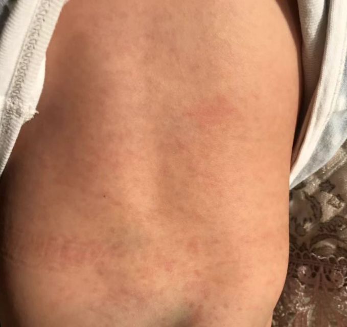 幼儿急疹几乎每个宝贝都逃不过,幼儿急疹每个孩子都出吗