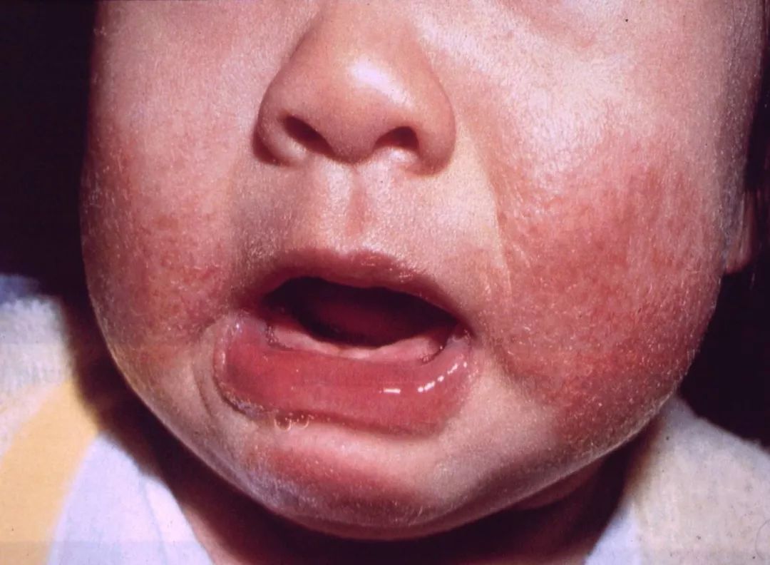 宝宝湿疹反反复复一直不好怎么办,宝宝湿疹反反复复该怎么办