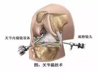 半月板损伤康复后能和之前一样么,三度半月板损伤手术几天出院