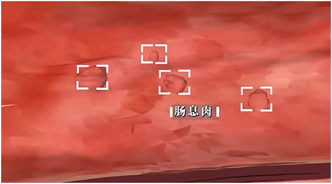 息肉癌变的前兆就是癌吗,息肉切了有癌细胞是癌症吗