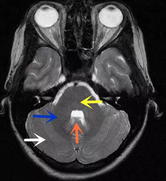 影像病例学习（3）：后颅窝实性占位病变