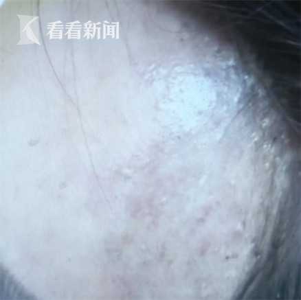 爱美之心需谨慎,注射玻尿酸脸部显现老态怎么办