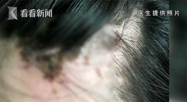 爱美之心需谨慎,注射玻尿酸脸部显现老态怎么办