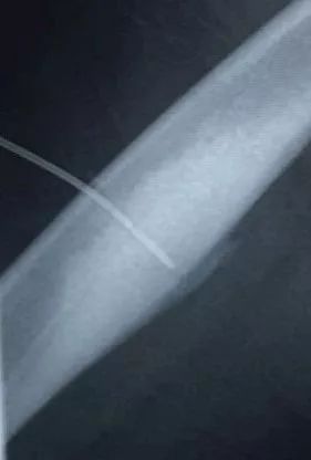 「安心过年」微创手术直击病灶！两骨瘤患者慕名而来，携健康回家