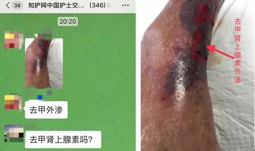 一般药物外渗的表现及处理方法,药物外渗多久会有反应