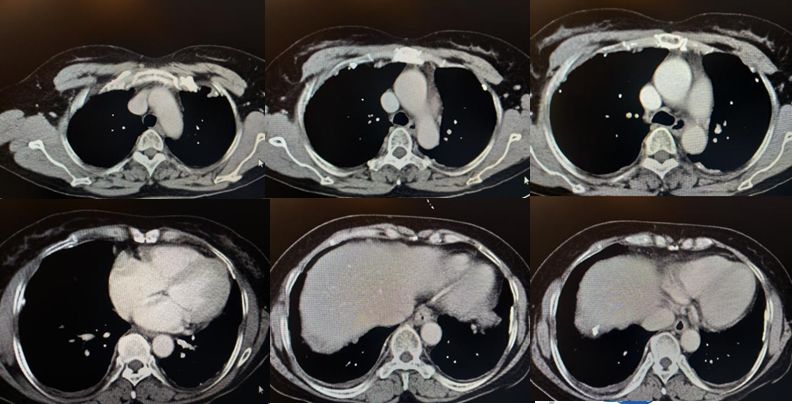 50岁女性胸腔积液是怎么形成的呢,26岁胸腔积液引起原因