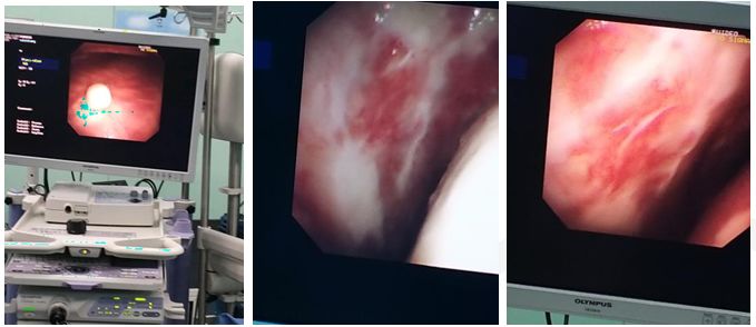 50岁女性胸腔积液是怎么形成的呢,26岁胸腔积液引起原因