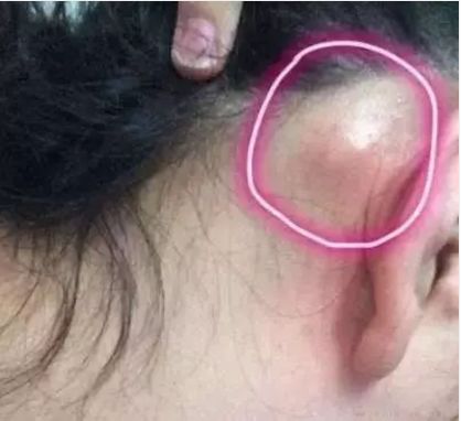 幼儿耳后鼓包怎么回事,你的耳后有鼓包吗