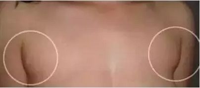 幼儿耳后鼓包怎么回事,你的耳后有鼓包吗