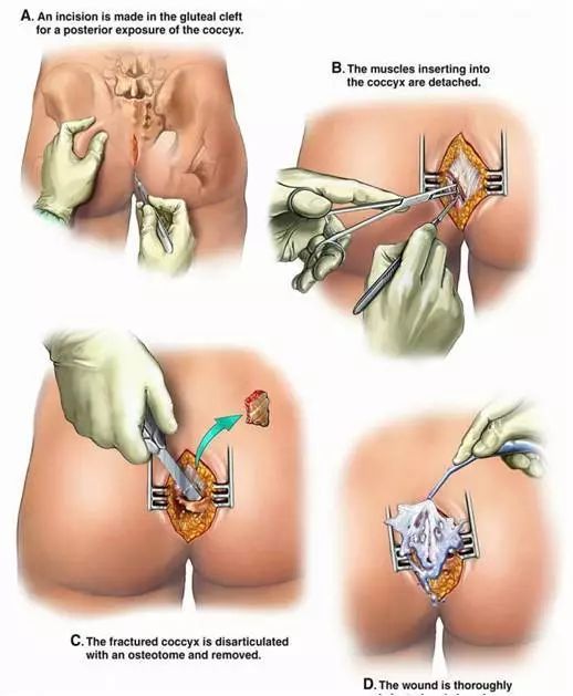 尾骨骨折赔偿价目表,尾骨骨折是什么症状