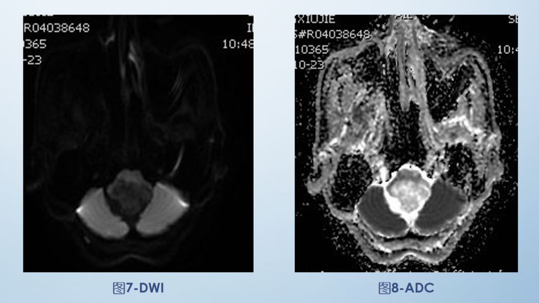 影像病例学习（3）：后颅窝实性占位病变