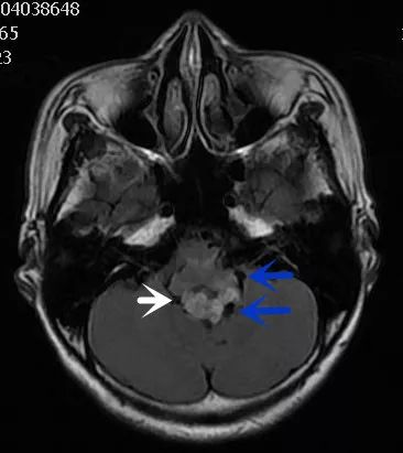 影像病例学习（3）：后颅窝实性占位病变