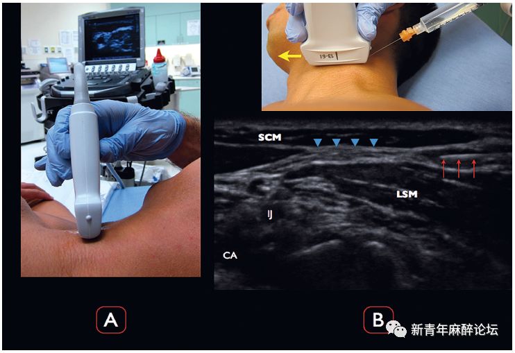落枕了怎么办最快最有效方法,落枕了怎么办按什么穴位