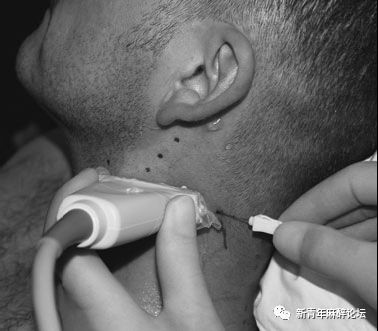 落枕了怎么办最快最有效方法,落枕了怎么办按什么穴位