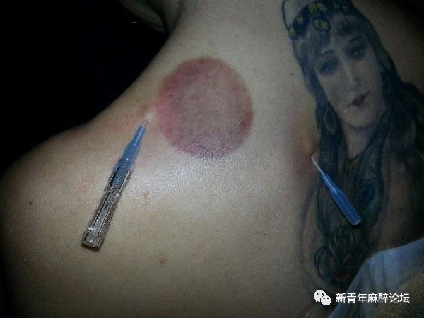 落枕了怎么办最快最有效方法,落枕了怎么办按什么穴位