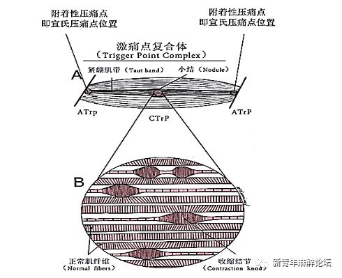 落枕了怎么办最快最有效方法,落枕了怎么办按什么穴位