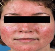 小分子靶向药物是什么,肺癌可以盲吃靶向药物吗