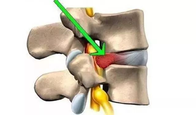 腰痛的根本原因你占了几项,腰痛是哪些疾病的征兆