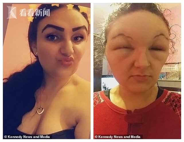 18岁女子染发剂过敏脸肿大一倍像“怪物”眼睛两天睁不开