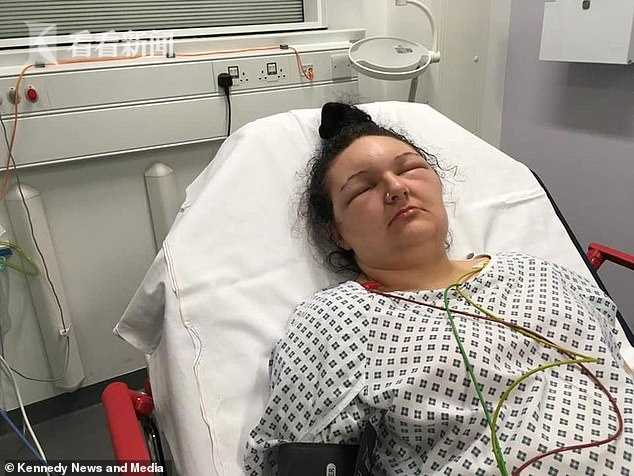 18岁女子染发剂过敏脸肿大一倍像“怪物”眼睛两天睁不开