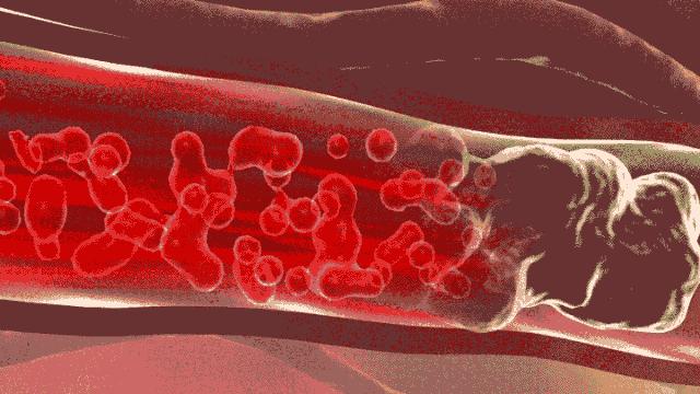 血管堵演示,血管堵塞100张图片