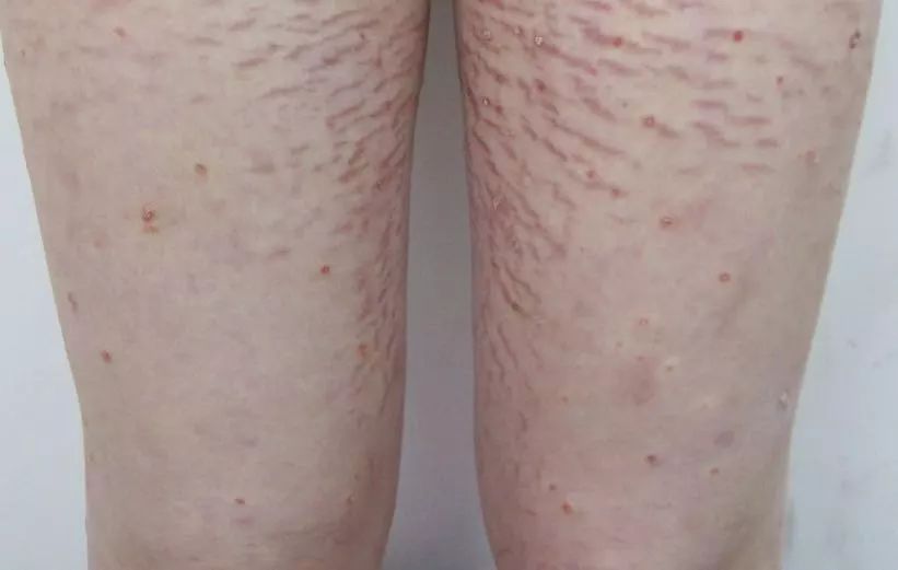 7岁儿童身上长黑毛,孩子身上长了很多黑毛怎么回事