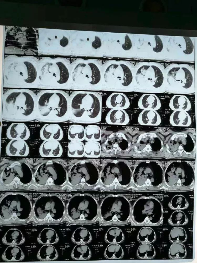渭北中心医院呼吸内科成功救治一例重症肺炎患者