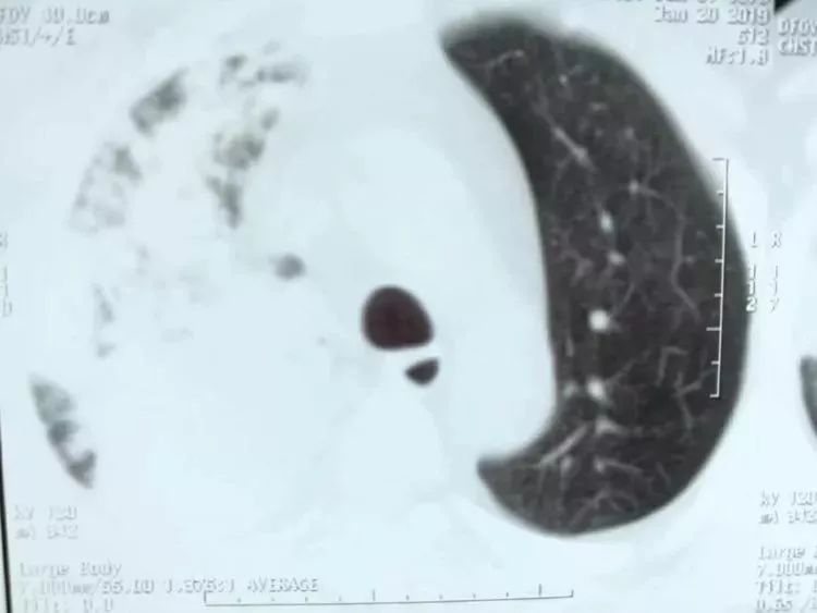 渭北中心医院呼吸内科成功救治一例重症肺炎患者