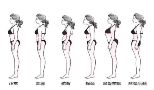 女人骨盆移位怎么办,女性骨盆倾斜怎么治疗