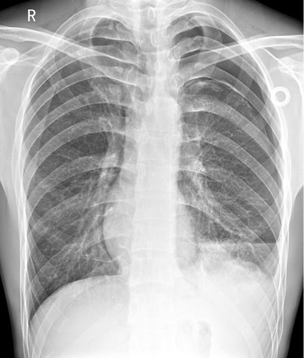 气胸的x线表现胸膜炎,胸外科气胸病人病例