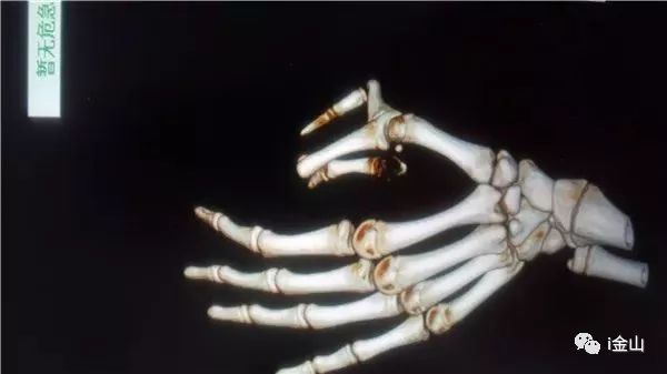 少年先天性多指感到自卑，爱心接力来金接受手术……