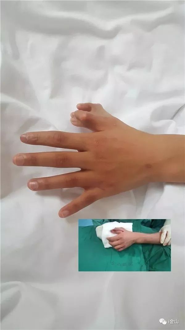 少年先天性多指感到自卑，爱心接力来金接受手术……