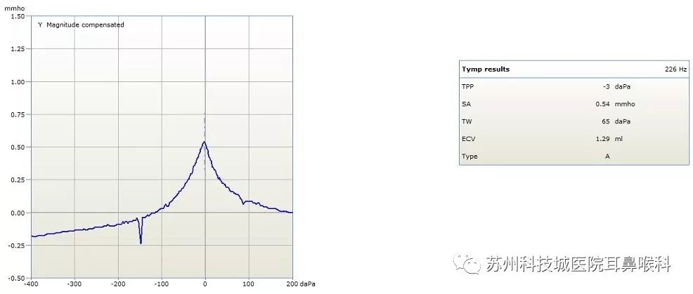 声导抗检测报告怎么看,声导抗测试报告中mep多少正常