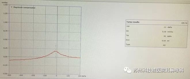 声导抗检测报告怎么看,声导抗测试报告中mep多少正常