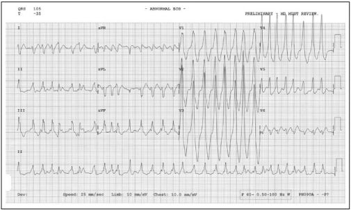 WPW综合征的心电图表现及治疗要点