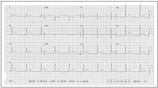 WPW综合征的心电图表现及治疗要点