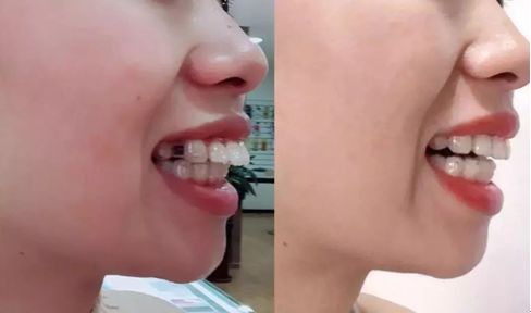 急急急！全城寻找缺牙、难看牙市民，每人最高获助20000元！