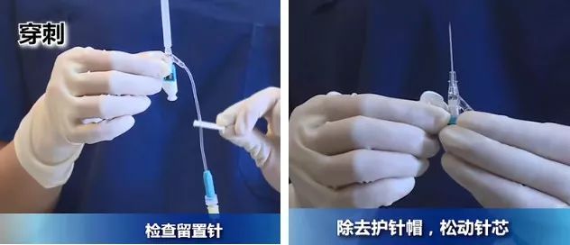 扎留置针有回血送针失败,留置针回血穿刺失败