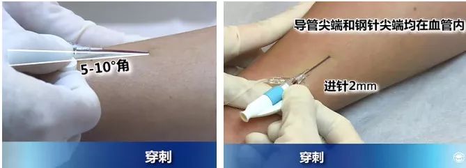 扎留置针有回血送针失败,留置针回血穿刺失败