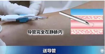 扎留置针有回血送针失败,留置针回血穿刺失败