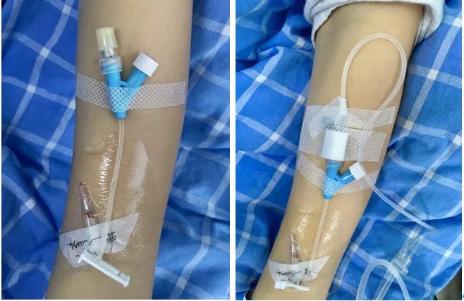 扎留置针有回血送针失败,留置针回血穿刺失败