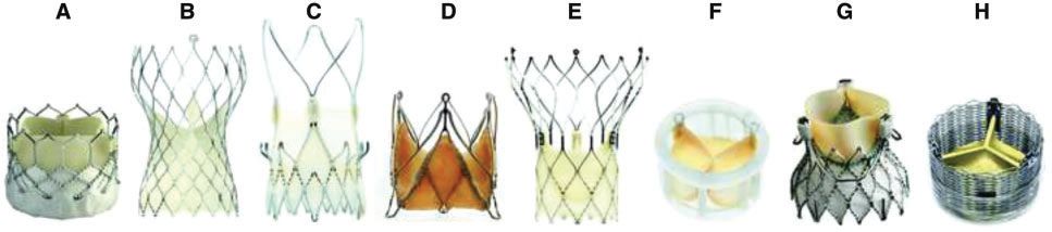 经导管瓣膜修复术费用,经导管介入治疗先天性心脏病