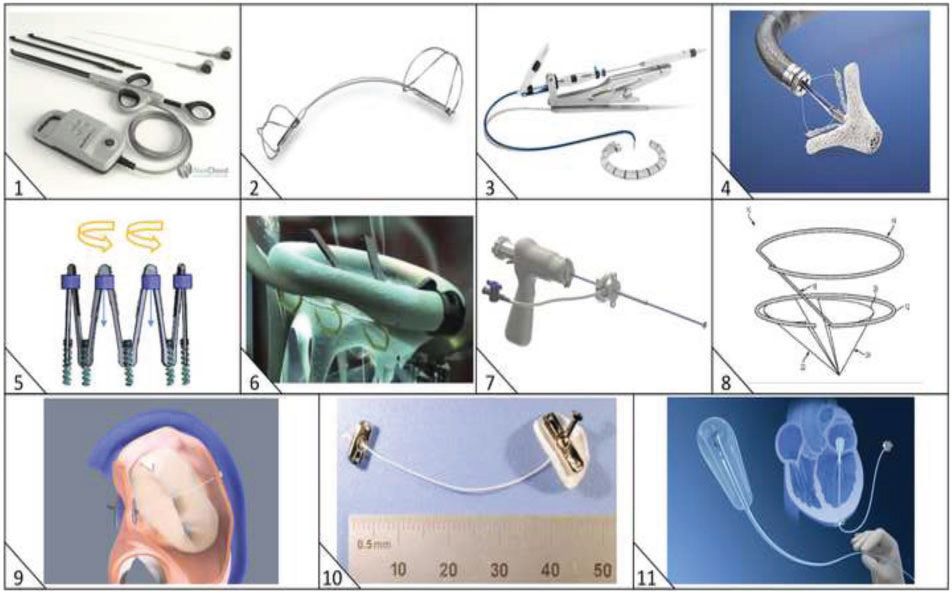 经导管瓣膜修复术费用,经导管介入治疗先天性心脏病