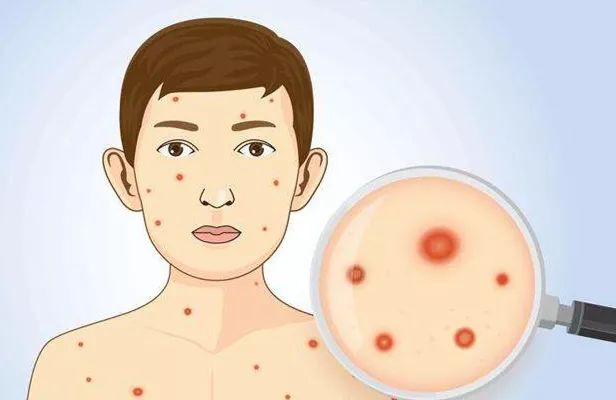 水痘进入高发期这些“战痘”知识你不能不知道