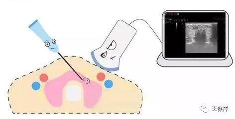 体检查出甲状腺结节需要重视吗,体检查出甲状腺结节应该怎么办