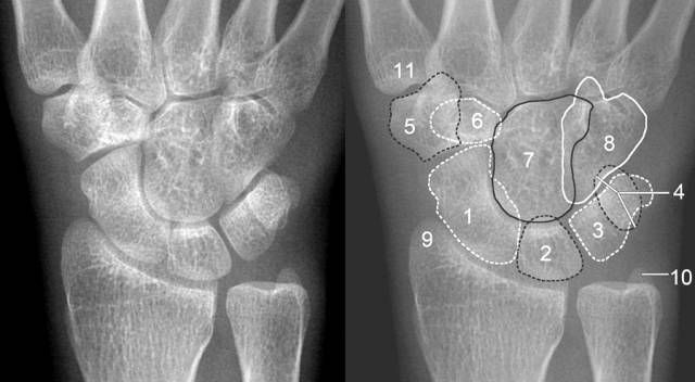 青少年尺腕关节脱位x线诊断标准,腕关节侧位x线片读片技巧
